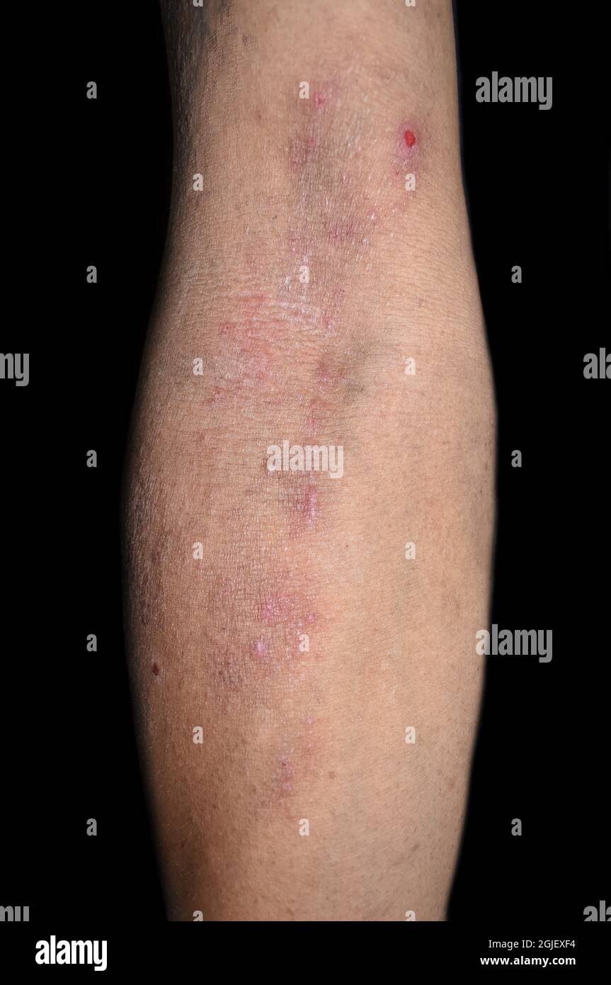 Vitamin b mangel -Fotos und -Bildmaterial in hoher Auflösung – Alamy