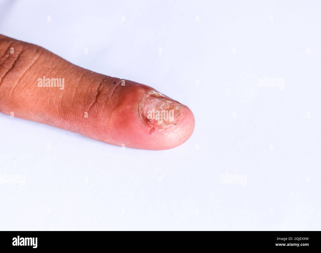 Beschädigter Fingernagel. Pilznagelinfektion. Onychomykose, auch Tinea unguium genannt. Stockfoto