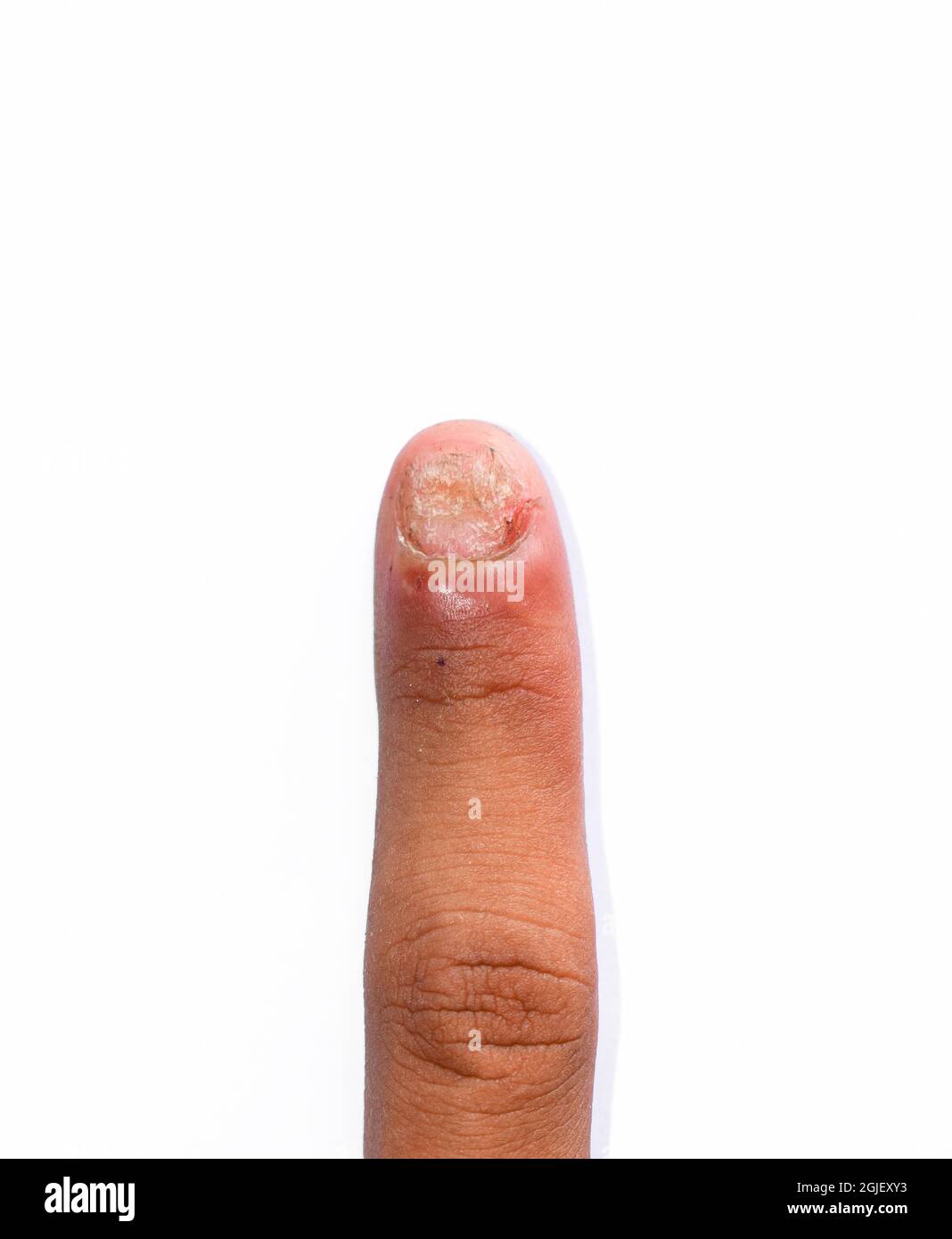 Beschädigter Fingernagel. Pilznagelinfektion. Onychomykose, auch Tinea unguium genannt. Stockfoto