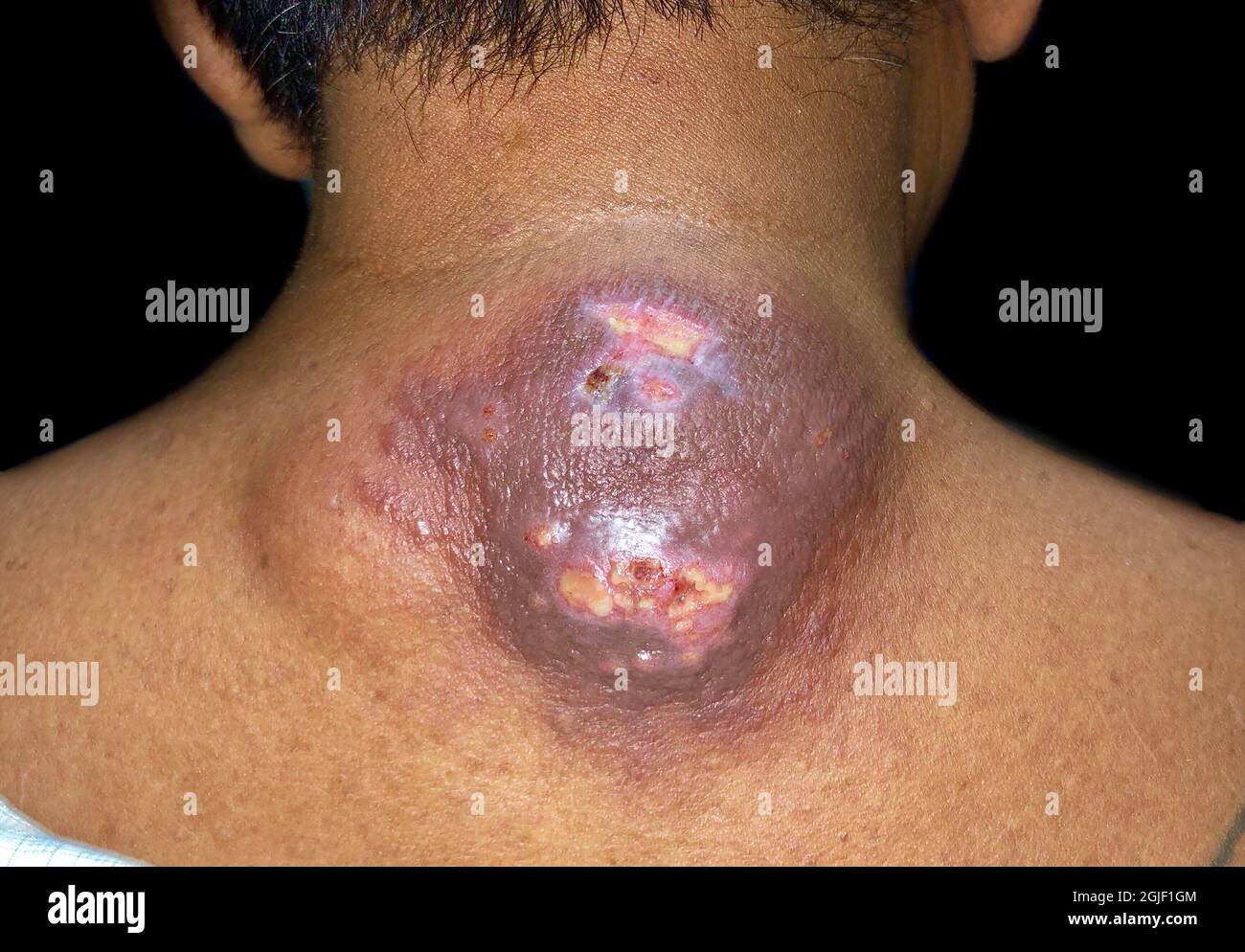 Großer Abszess mit umgebender Cellulitis oder Staphylokokken, Streptokokken-Hautinfektion am oberen Rücken eines männlichen asiatischen Patienten aus Burma. Stockfoto