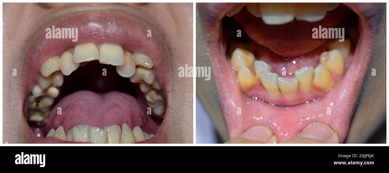 Gestapelte oder überlappende Zähne des asiatischen Mannes. Auch gedrängte Zähne genannt. Nahaufnahme. Stockfoto