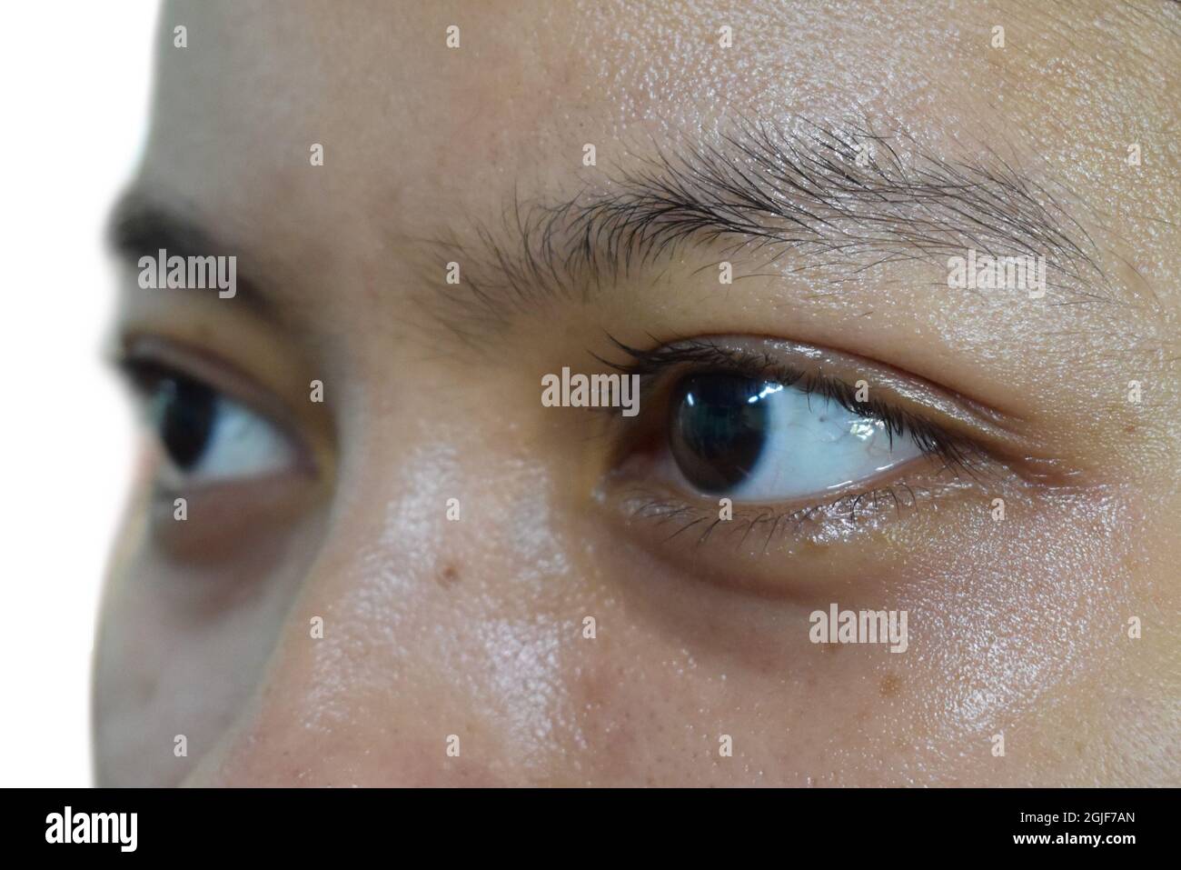 Dunkle Kreise um die Augen der asiatischen Frau. Braune Verfärbung der Augenlider. Isoliert auf Weiß. Stockfoto