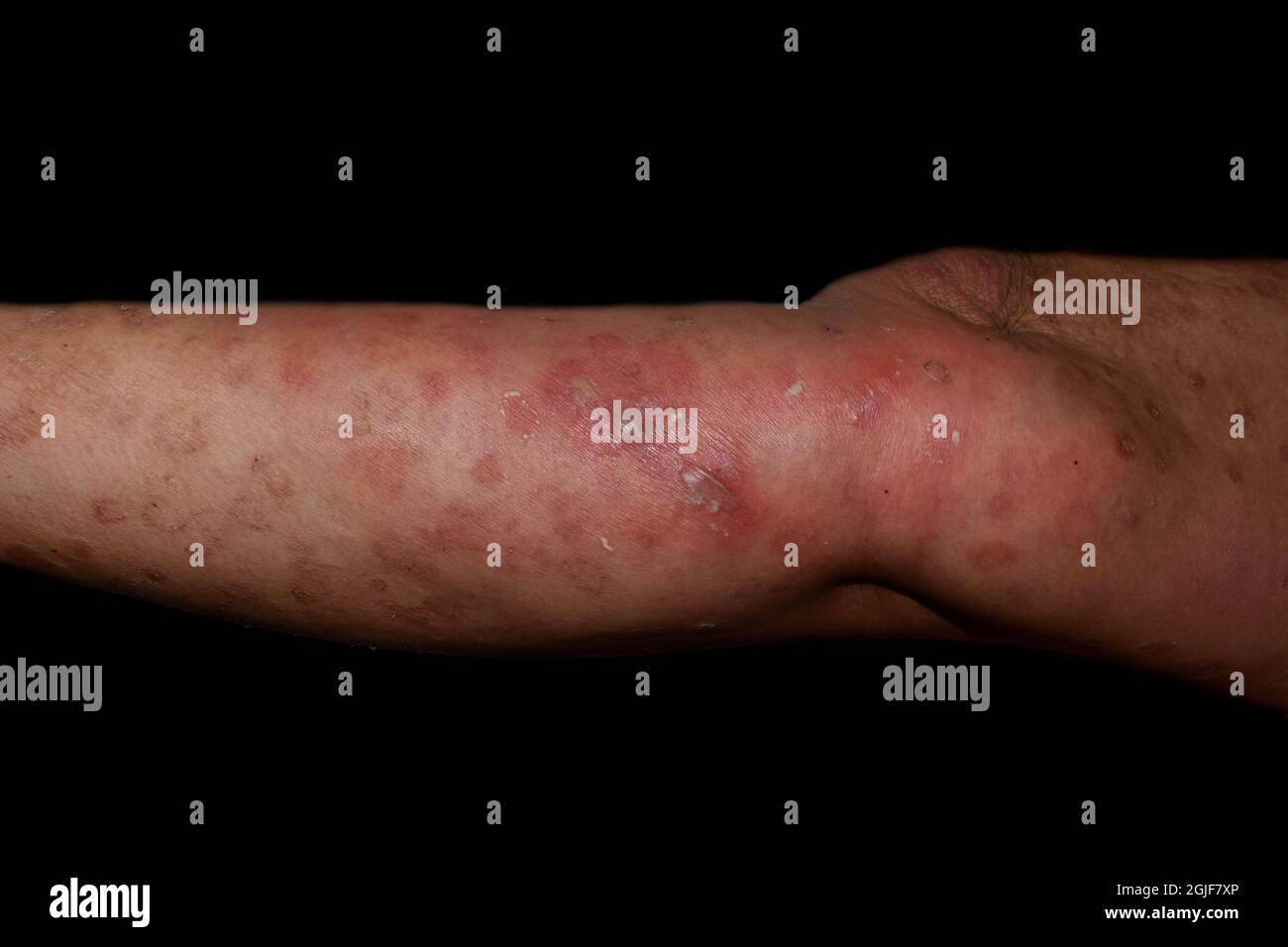 Bullöse impetigo -Fotos und -Bildmaterial in hoher Auflösung – Alamy