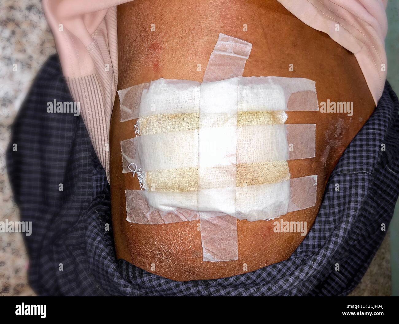 Medizinischer Wundverband für Injektionsabszess im Gesäß. Unsteril. Stockfoto Medizinischer Wundverband für Injektionsabszess im Gesäß. Unsteril. Stockfoto
