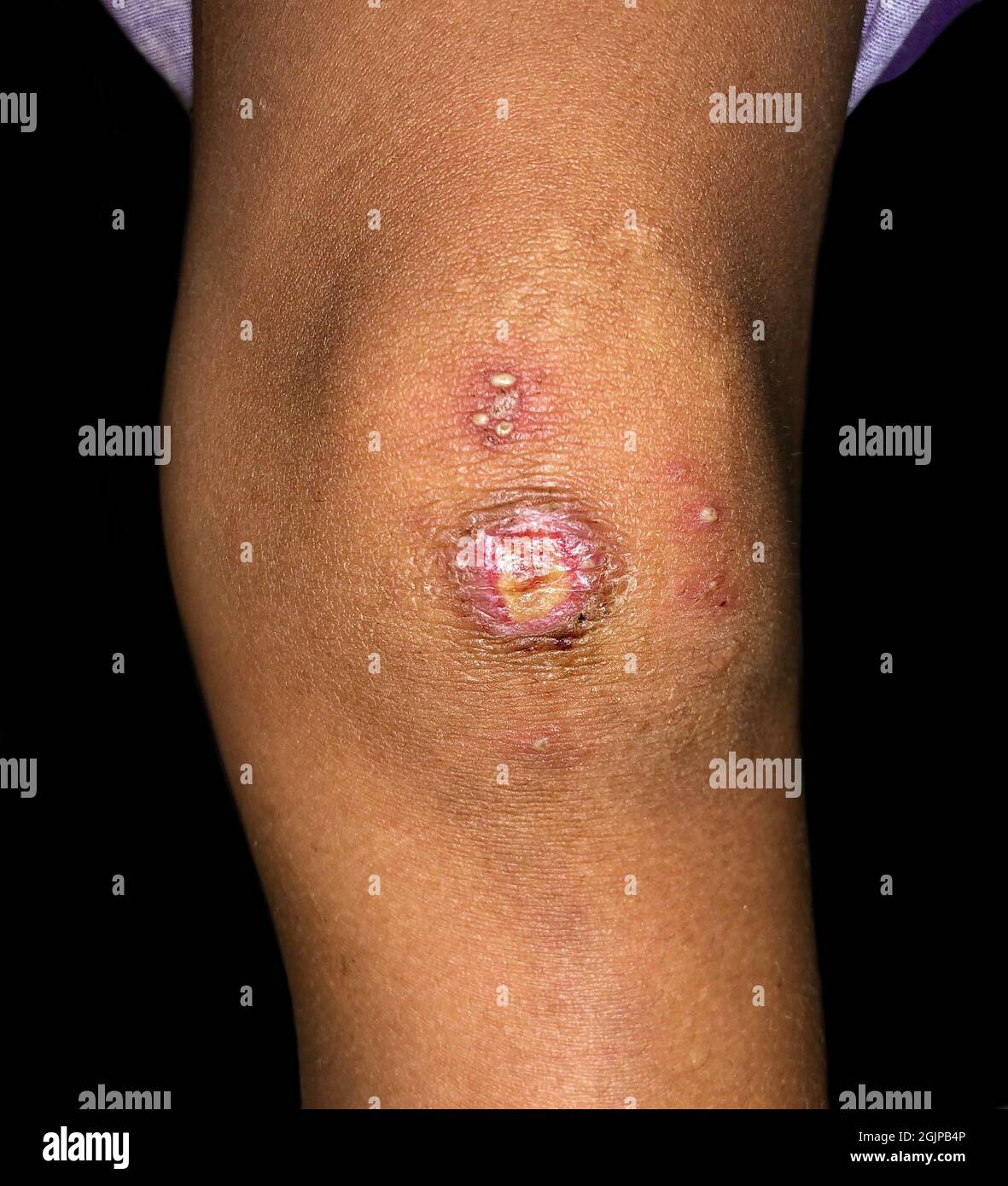 Furunkel oder Staphylokokken-Infektion am Bein eines asiatischen Kindes. Auch als kocht bezeichnet. Schmerzhafte Hautläsionen. Stockfoto