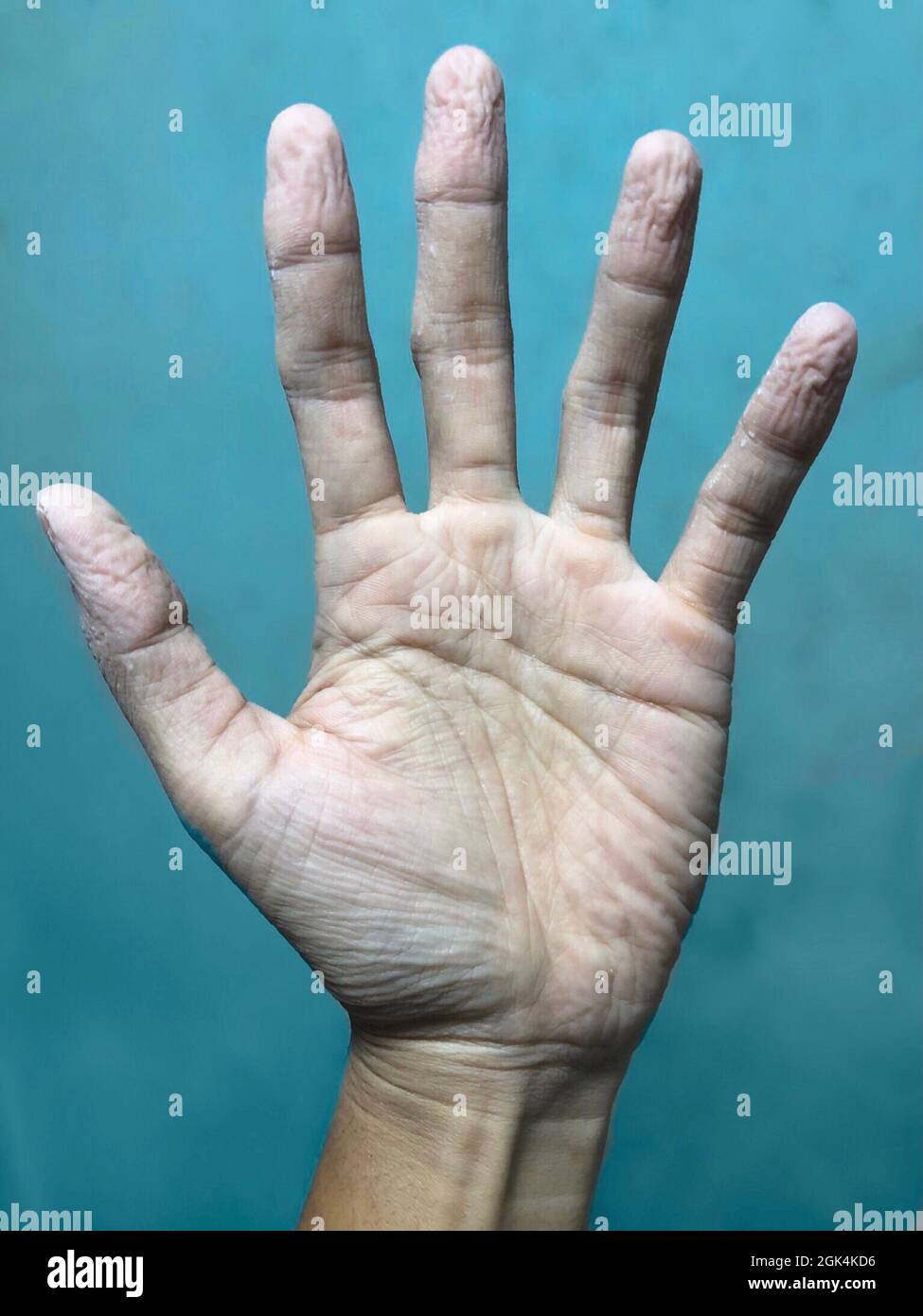 Pruney Hand durch langes Einweichen im Wasser. Die Haut der Hand schrumpft. Ungesunde Hand. Stockfoto