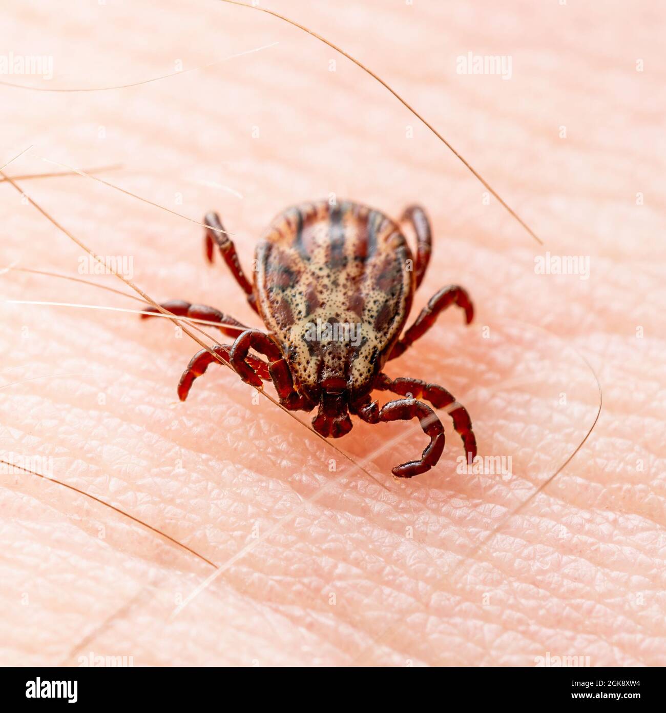 Encephalitis Virus oder Lyme-Borreliose infizierte Dermacentor Tick Arachnid Parasit Insekt auf der Haut Close-up Stockfoto