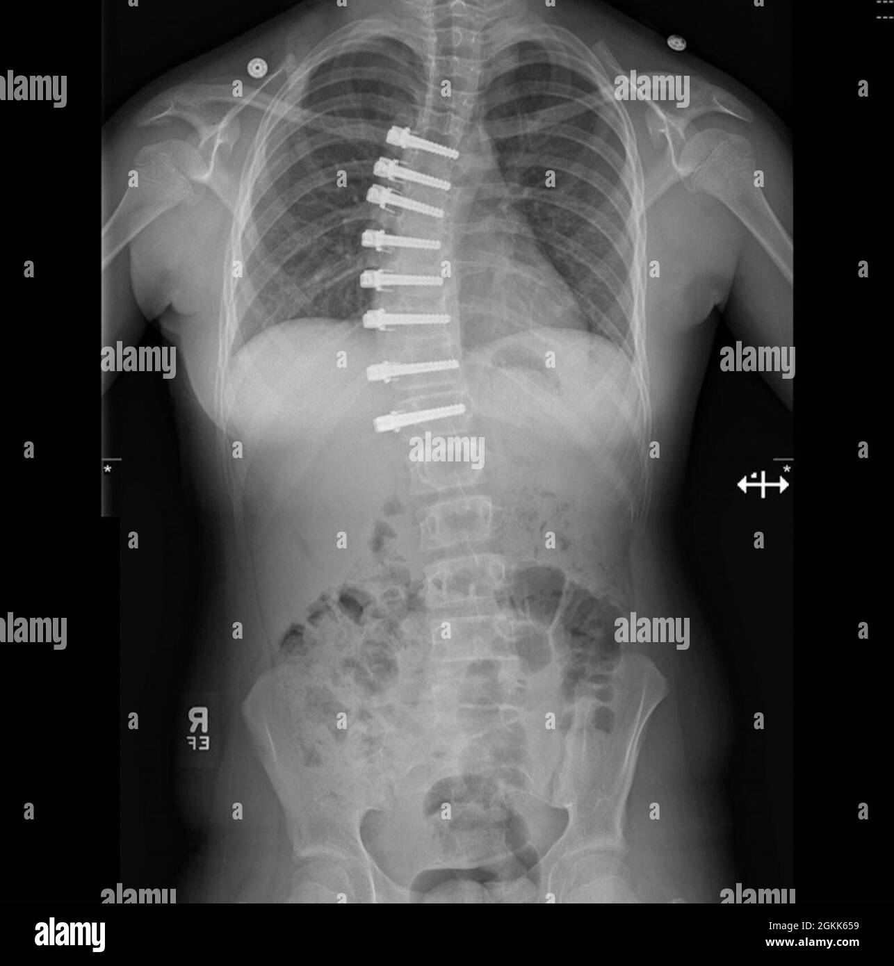 Postoperatives Röntgen der Wirbelkörper-Tethering bei Patienten-Boyll Stockfoto