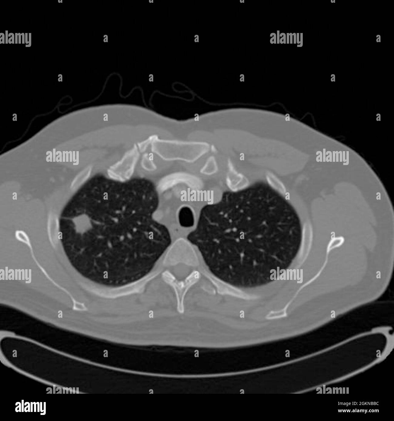CT-Thoraxaufnahme (Röntgen-Computertomographie) eines männlichen 54-jährigen Patienten. Im linken oberen Lappen seiner Lunge ist ein Tumor zu sehen Stockfoto