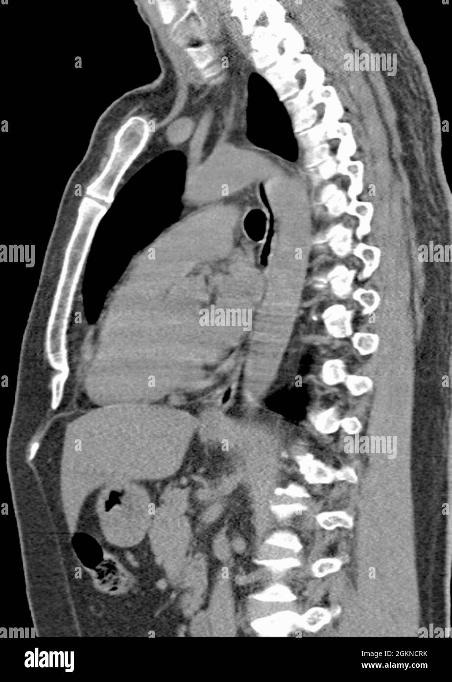 Röntgen-Computertomographie (CT) der Brustseitenansicht eines erwachsenen Mannes Stockfoto
