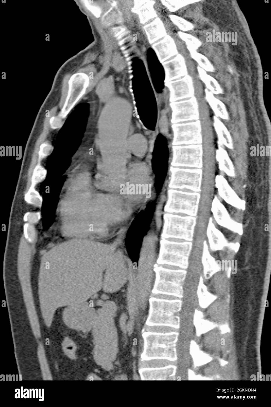 Röntgen-Computertomographie (CT) der Brustseitenansicht eines erwachsenen Mannes Stockfoto