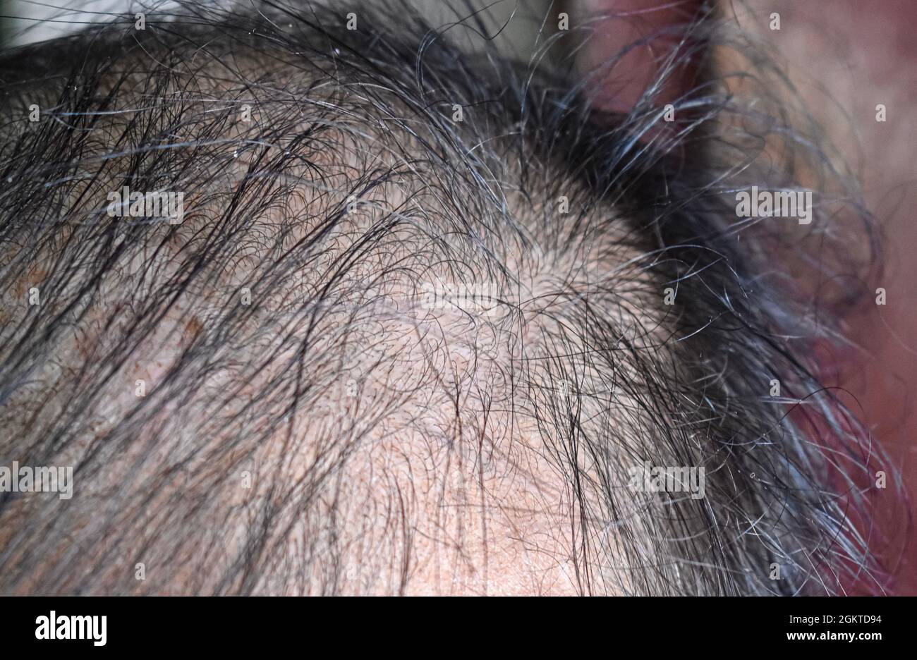 Dünner werdendes oder spärliches Haar, Haarausfall nach männlichem Muster im südostasiatischen, chinesischen älteren Mann. Stockfoto