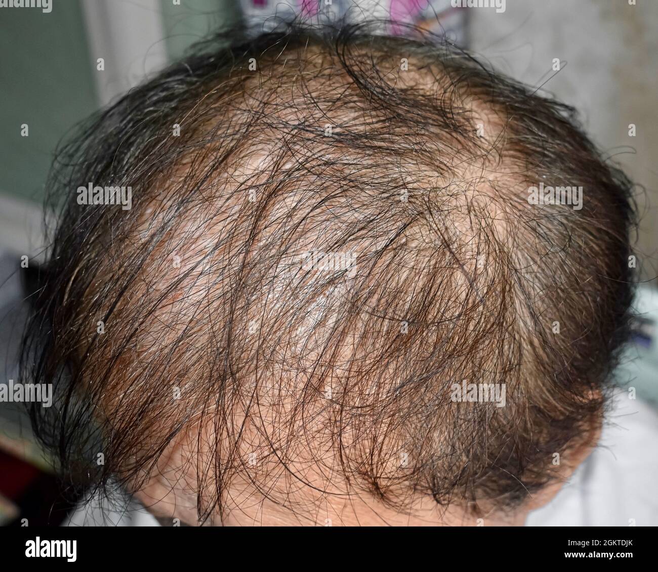 Dünner werdendes oder spärliches Haar, Haarausfall nach männlichem Muster im südostasiatischen, chinesischen älteren Mann. Stockfoto