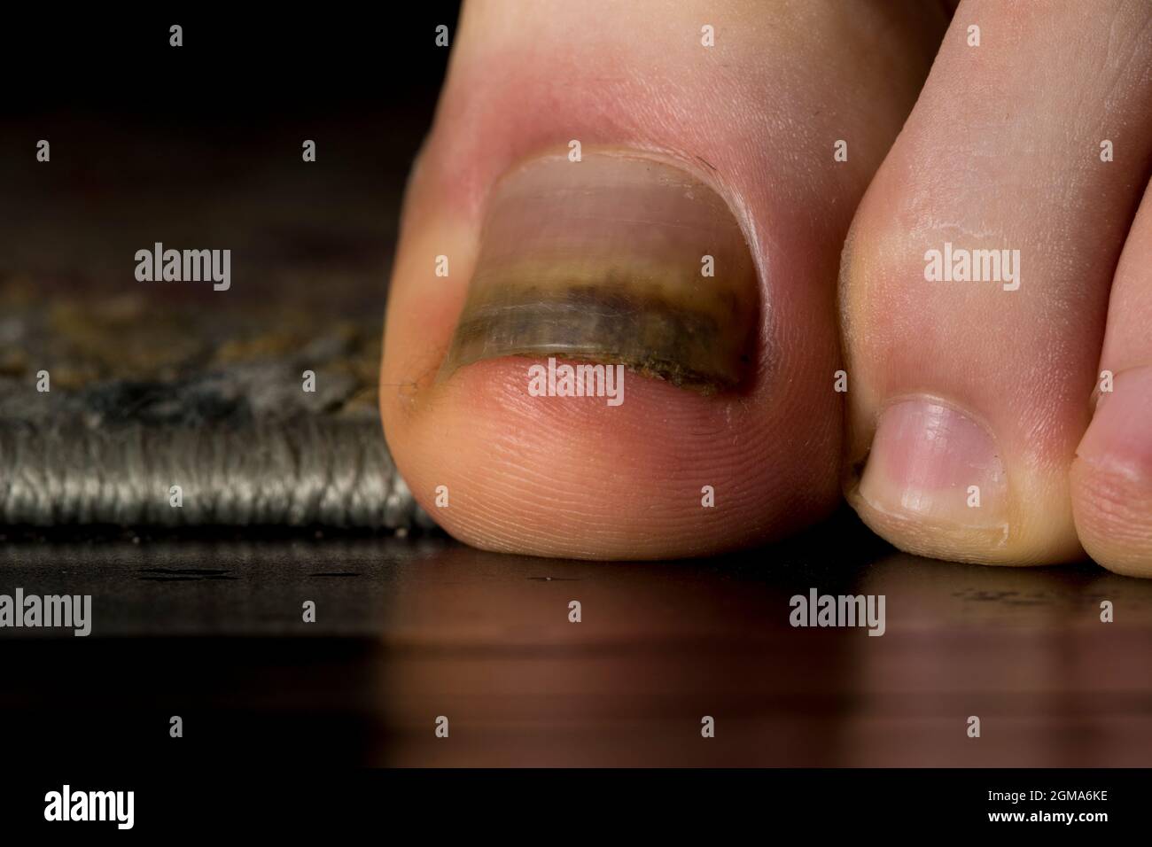 Verletzte Nagelbett Zehen Nagel Trauma Nahaufnahme Zehennagel. Stockfoto