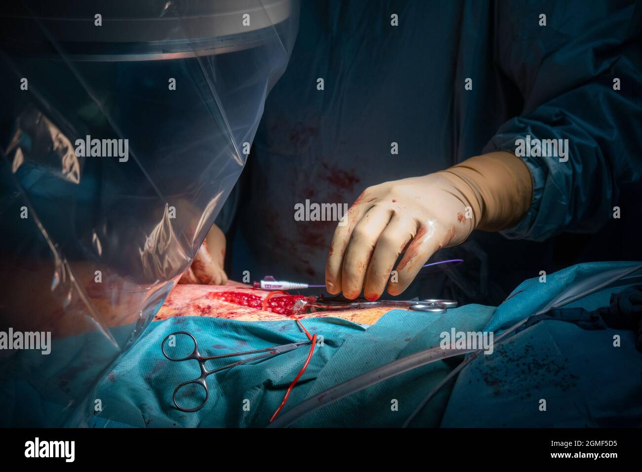 In einem Operationssaal wird eine Gefäßoperation durchgeführt Stockfoto
