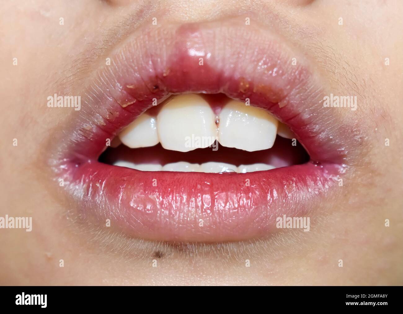 Eckige Stomatitis oder eckige Cheilitis oder Perleche beim asiatischen kleinen Jungen. Häufige entzündliche Erkrankung der Mundwinkel. Trockene Gesichtshaut und Lippen. Stockfoto