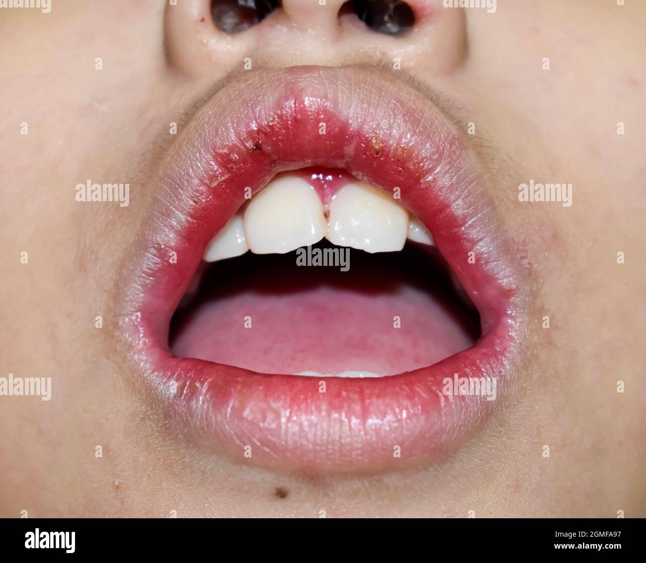 Eckige Stomatitis oder eckige Cheilitis oder Perleche beim asiatischen kleinen Jungen. Häufige entzündliche Erkrankung der Mundwinkel. Trockene Gesichtshaut und Lippen. Stockfoto
