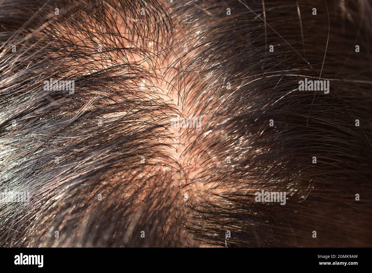 Nahaufnahme der Kopfschwarte, Alopezie Stockfoto