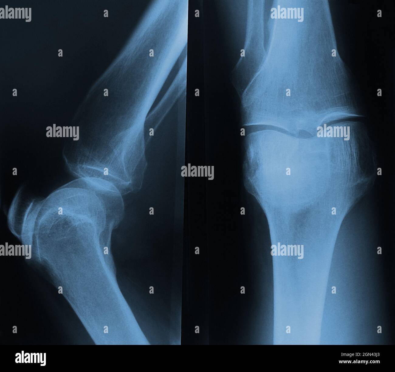 Röntgenaufnahme des Knies. Vorne und seitlich Stockfoto