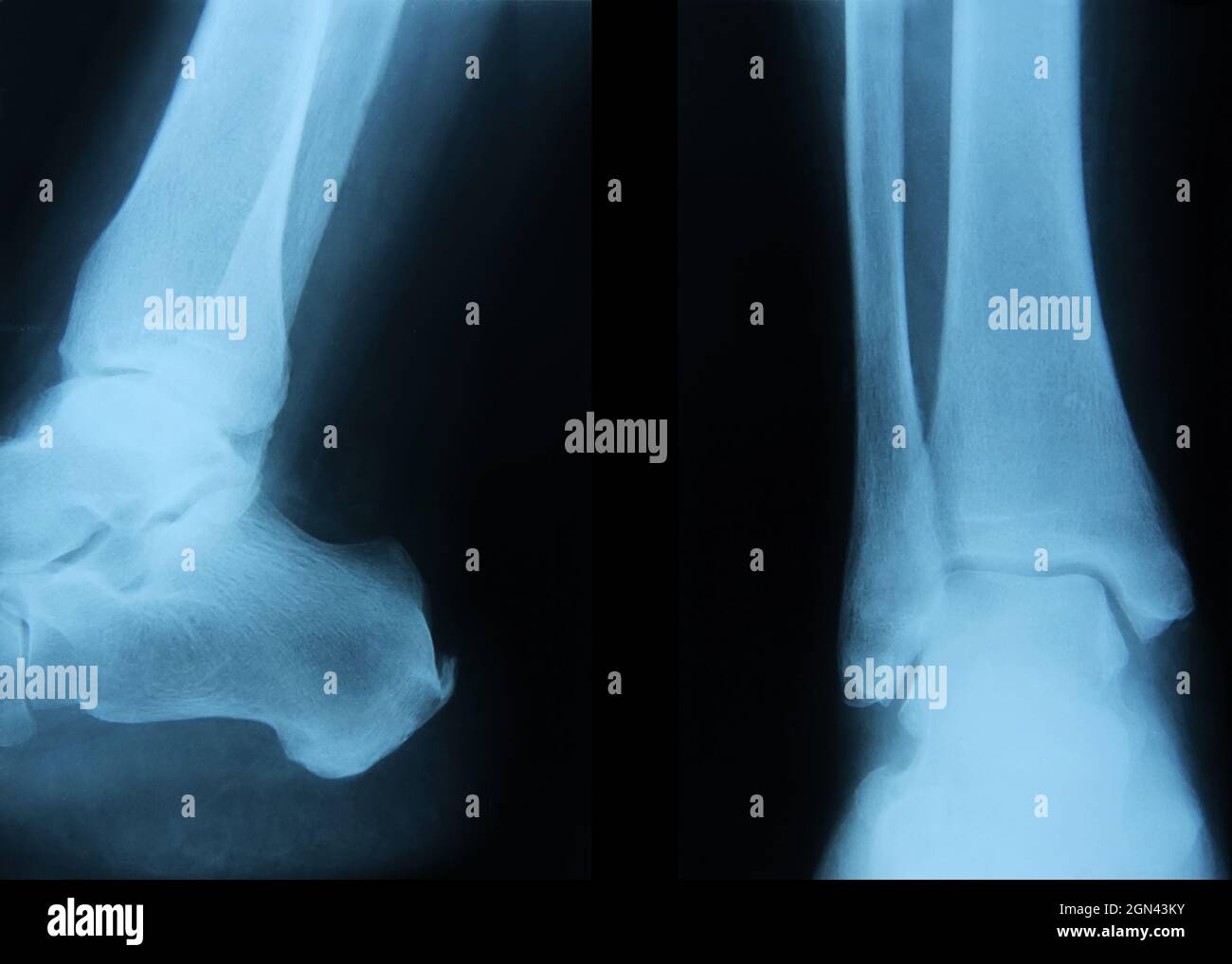 Röntgenaufnahme des menschlichen Knöchelgelenks. Stockfoto