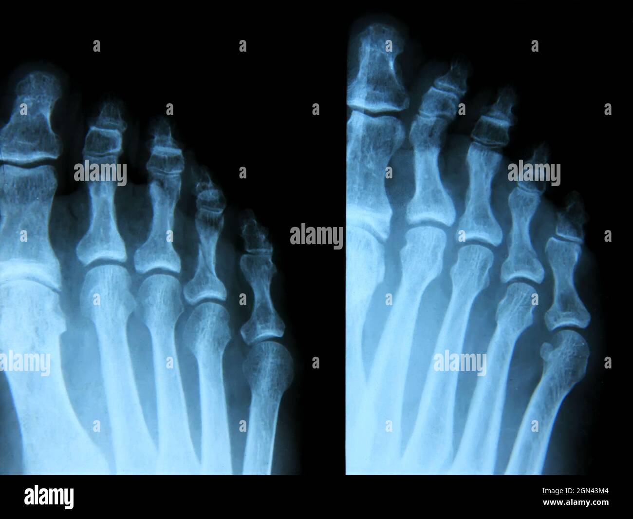 Röntgenaufnahme des rechten Fußes. Stockfoto