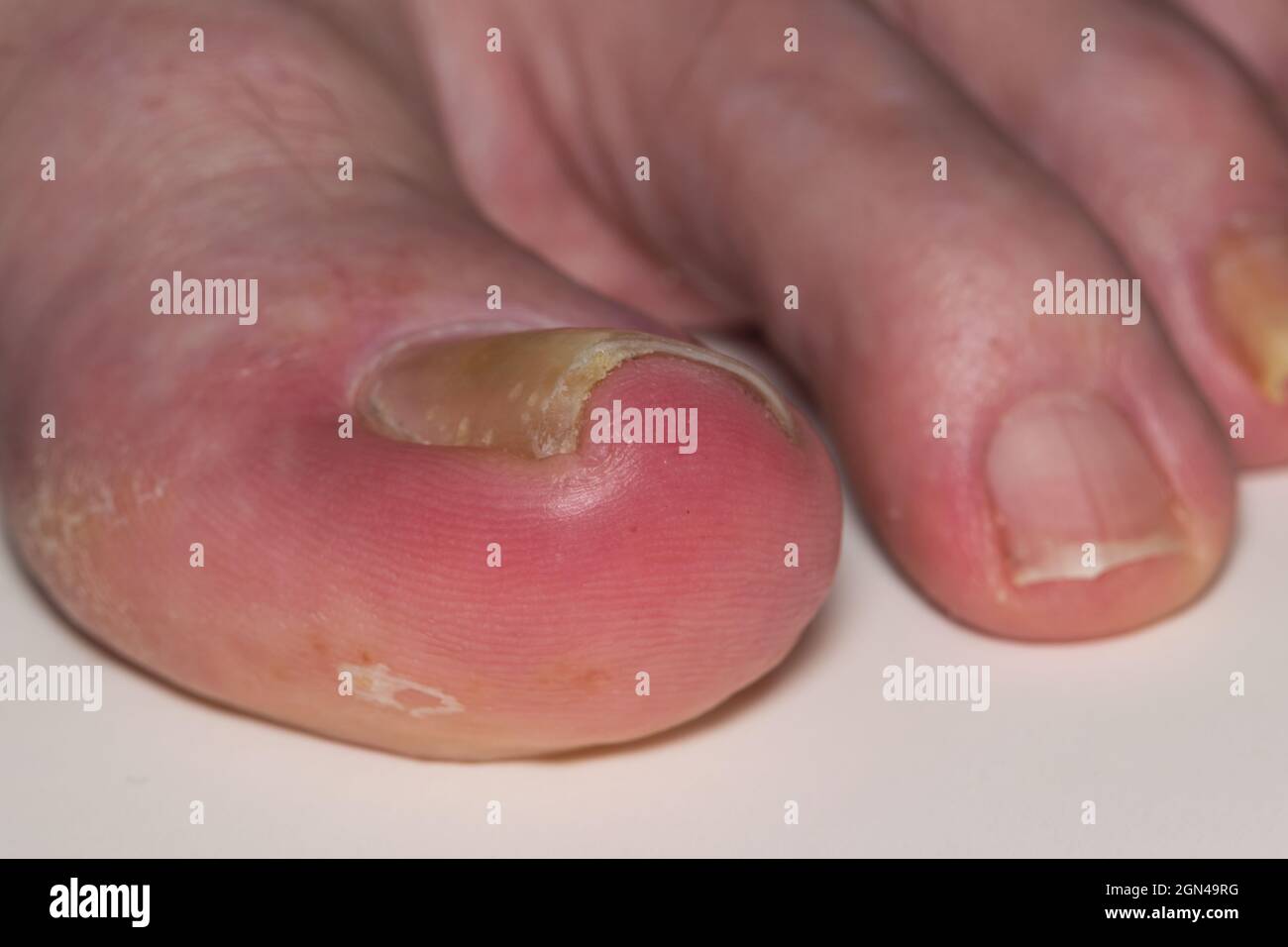 Eingewachsene Zehennagel-Onychocryptose auf kaukasischen Großzehe Hallux, verursacht durch Pilzinfektion Tinea unguium. Makro-abgewinkelte Ansicht mit kleineren Ziffern sichtbar. Stockfoto