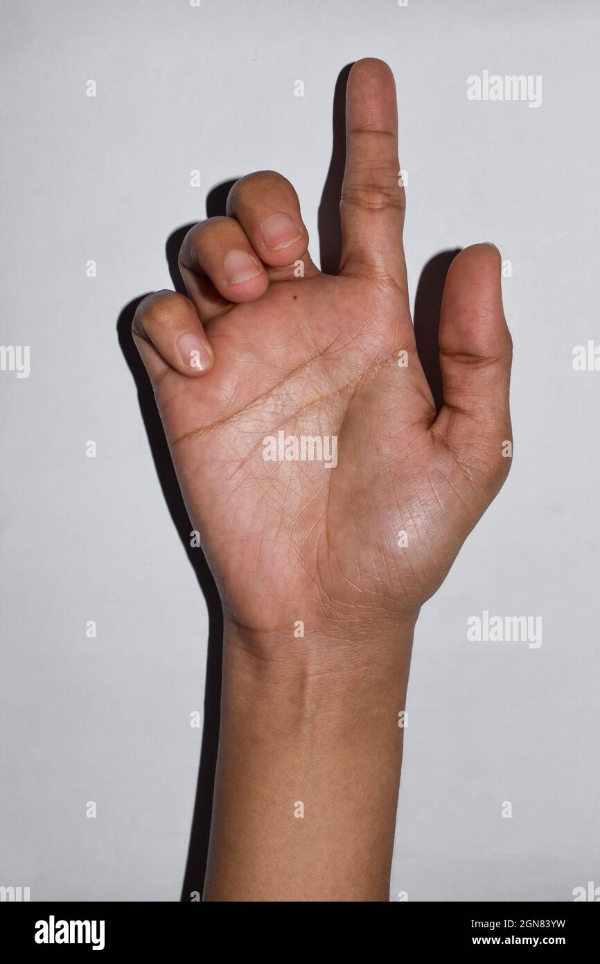 Ulnar Klaue Hand der asiatischen jungen Frau. Auch bekannt als 'Spinsterkralle. Entwickelt sich aufgrund ulnar Nervenschäden verursacht Lähmung der lumbricals. Stockfoto