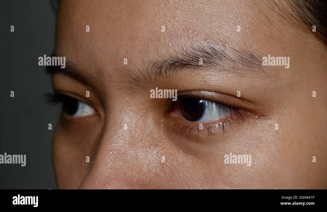 Doppelte Augenlider der asiatischen jungen Frau mit fettigem Gesicht. Stockfoto