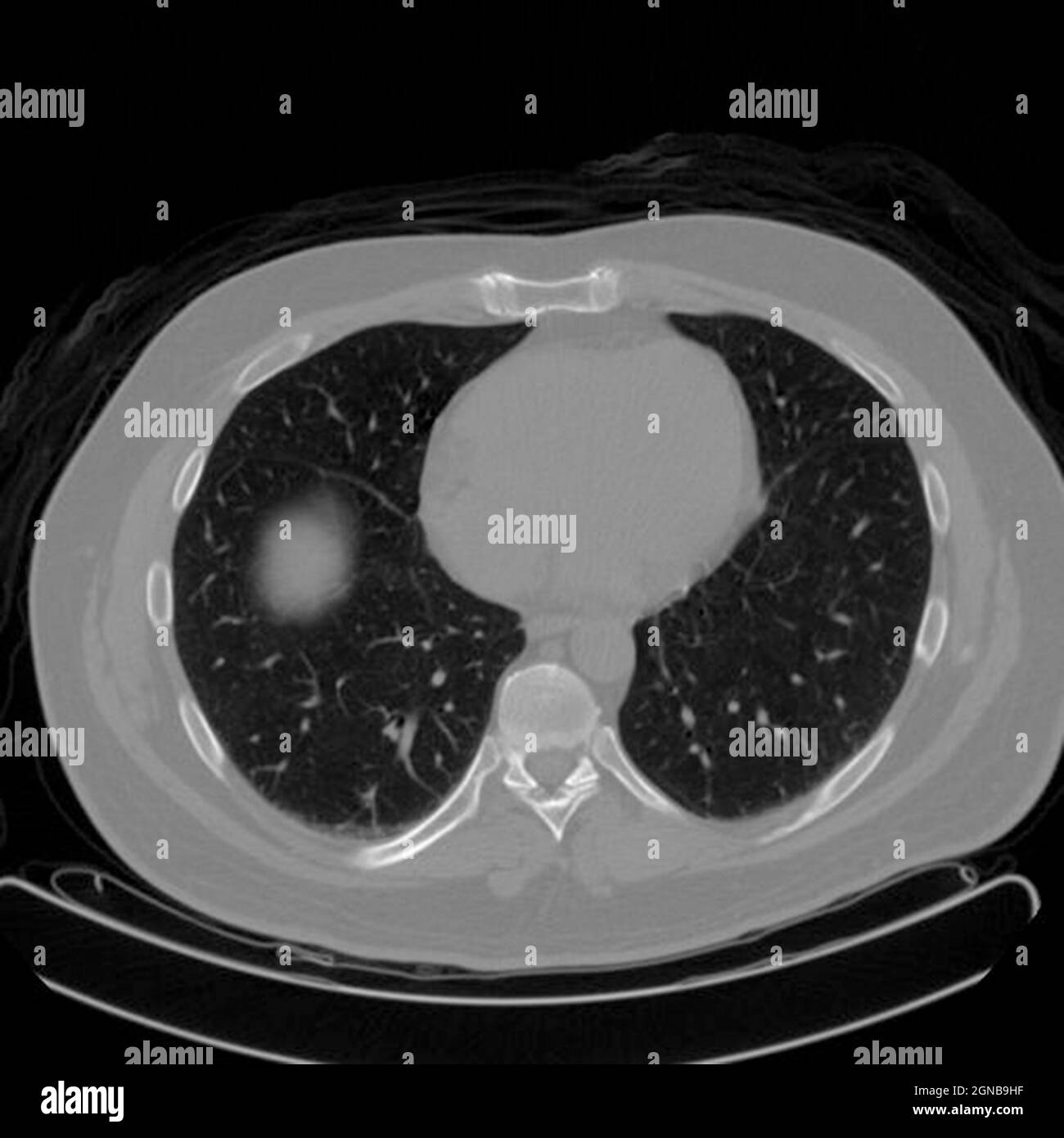 Positronen-Emissions-Tomographie (PET) eines männlichen, 54 Jahre alten Patienten. Im linken oberen Lappen seiner Lunge ist ein Tumor zu sehen Stockfoto