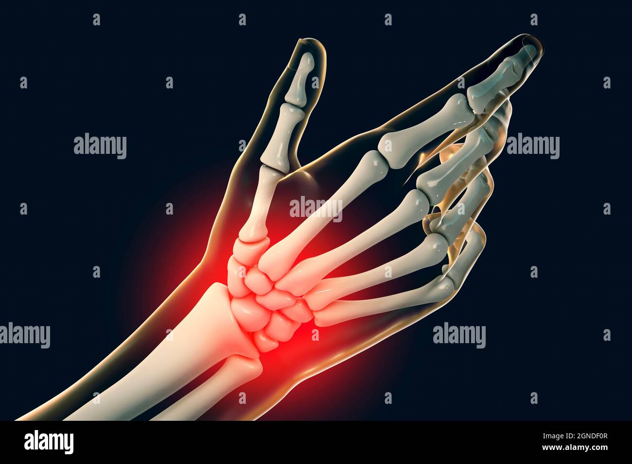 Schmerzhaftes Handgelenk, Illustration Stockfoto