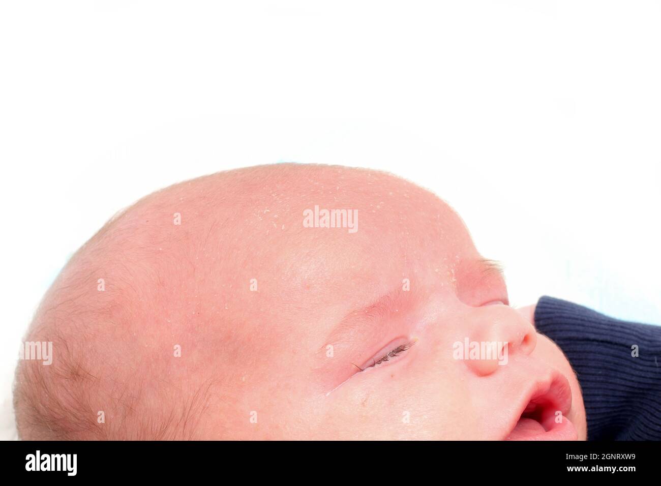 Das Detail des Kopfes des unglücklich weinenden neugeborenen Jungen mit Hautproblemen. Er hat Seborea und Akne. Stockfoto