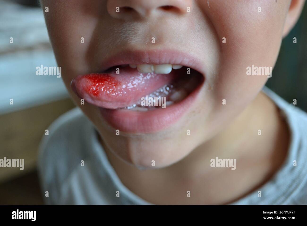 Nahaufnahme von Lippen, Zunge, Blutvorsprüngen. Gebissene Zunge des Kindes. Stockfoto