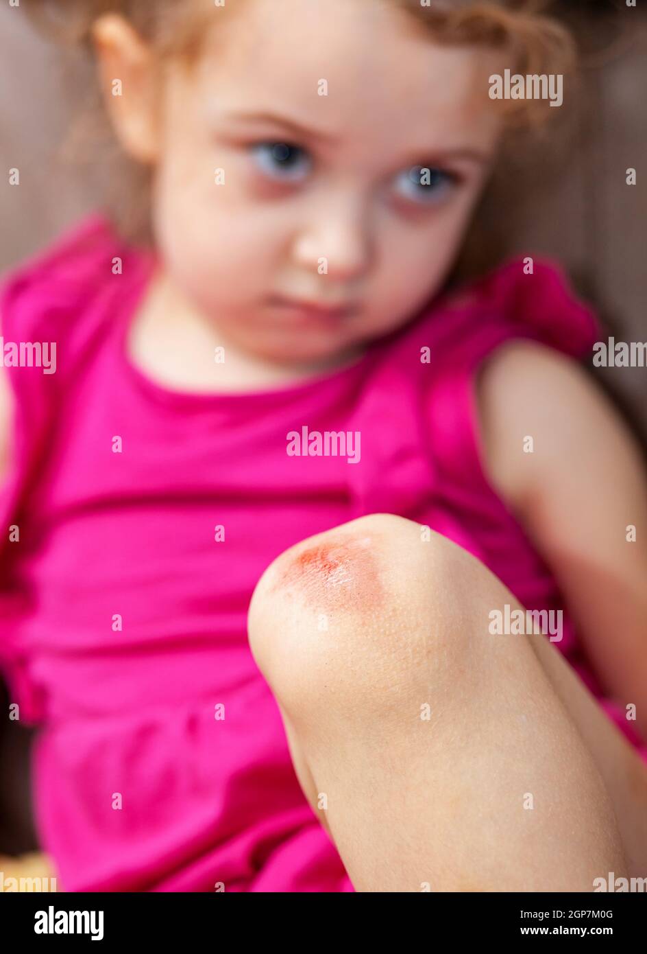 Verwundete Knie des Kindes, Abschürfungen auf den Knien des Babys. Stockfoto