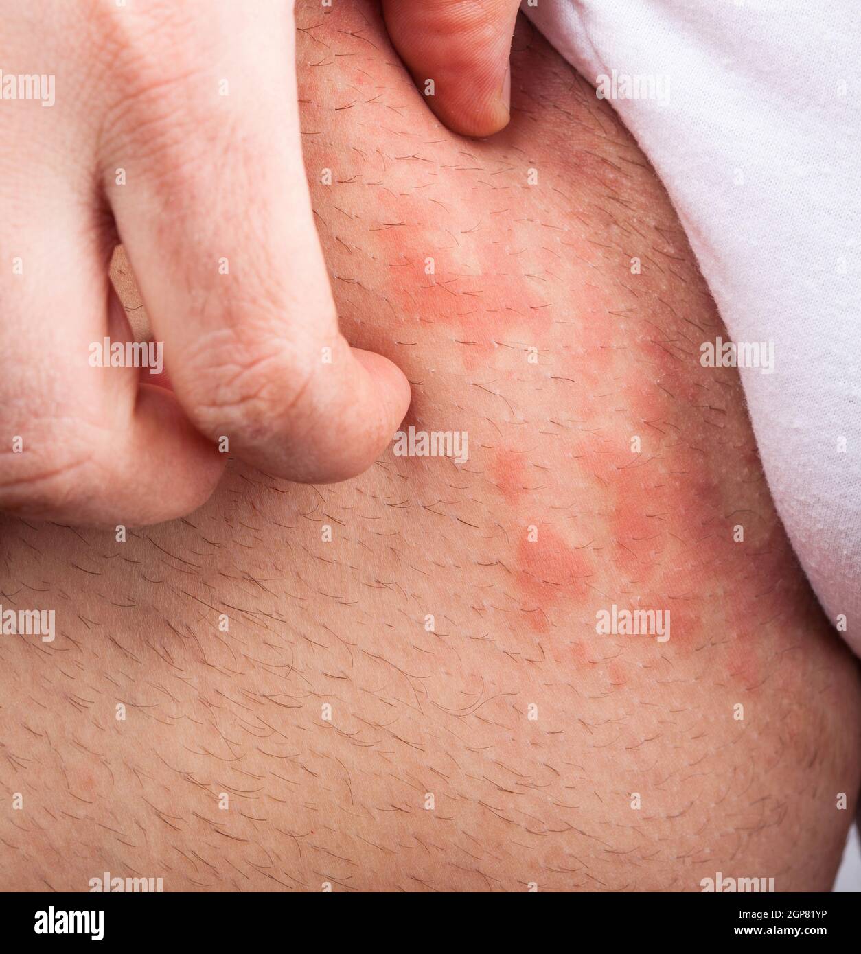 Ekzem Leistengegend atopischer Dermatitis Symptom der Hautstruktur Stockfoto