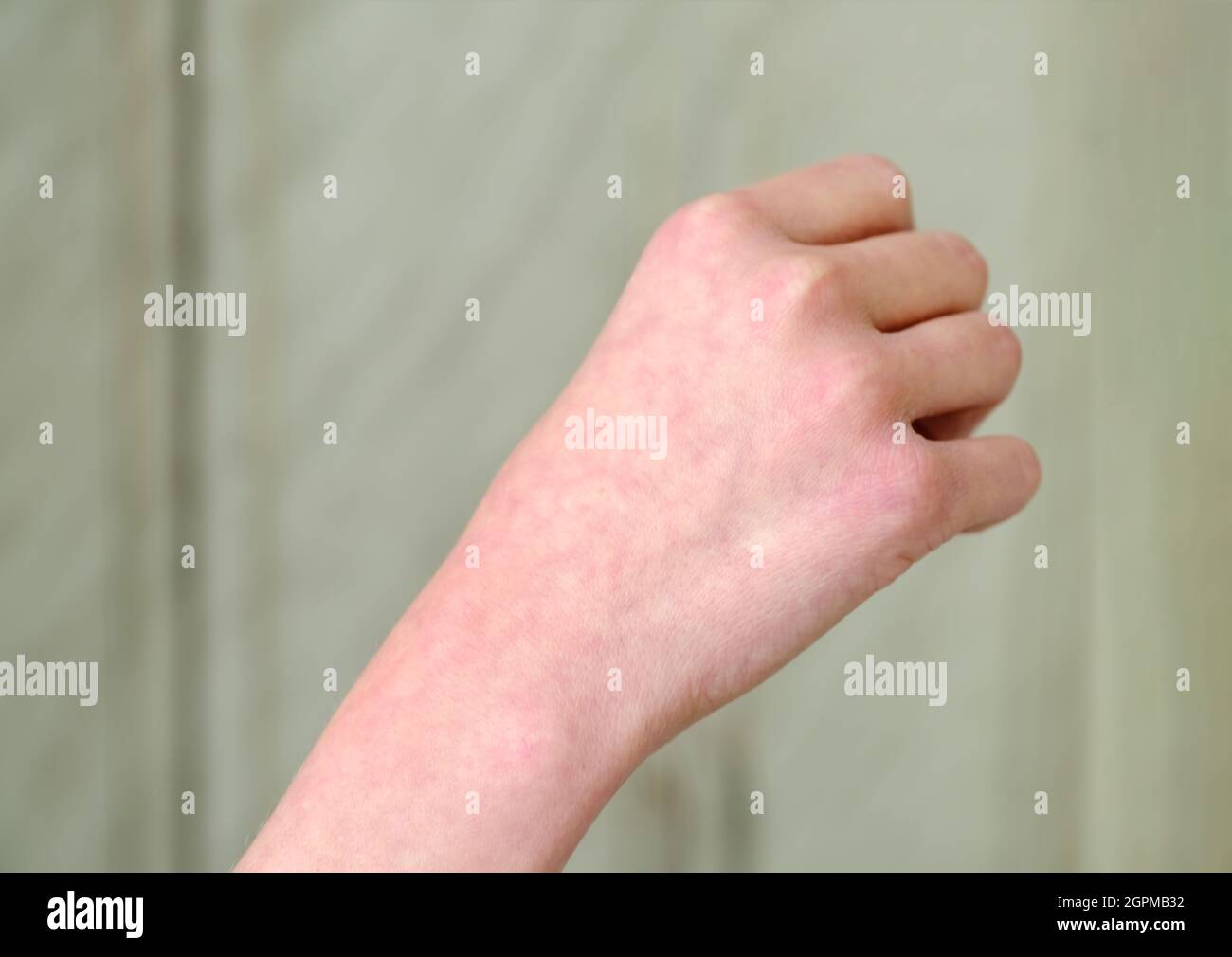 Marmorierung der Haut. Cutis marmorata telangiectatica congenita ist eine seltene angeborene Erkrankung, Gefäßpathologie Stockfoto