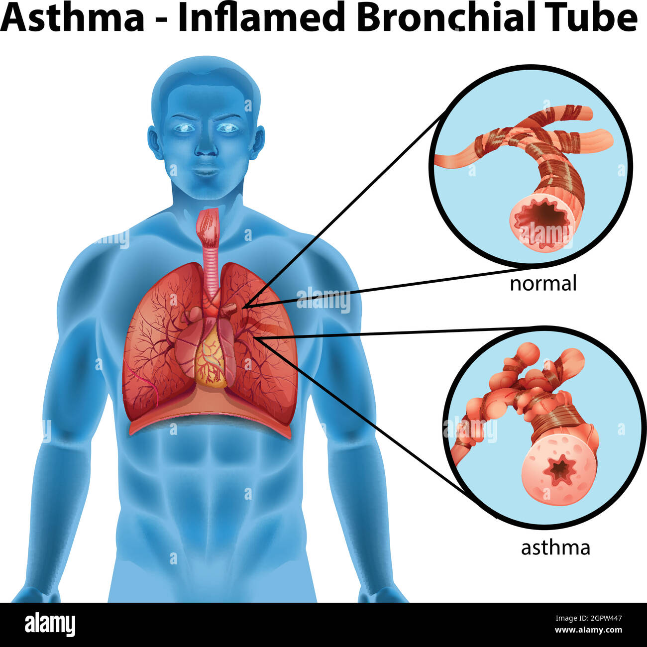 Asthma-entzündeter Bronchialschlauch Stock Vektor