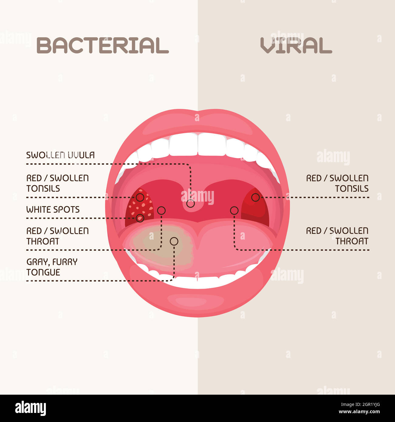Kehle bakterielle und virale Infektion, Mandeln Entzündung. Stock Vektor