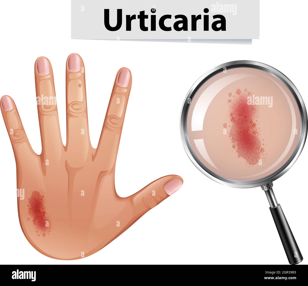 Urtikaria vergrößert auf der Hand Stock Vektor
