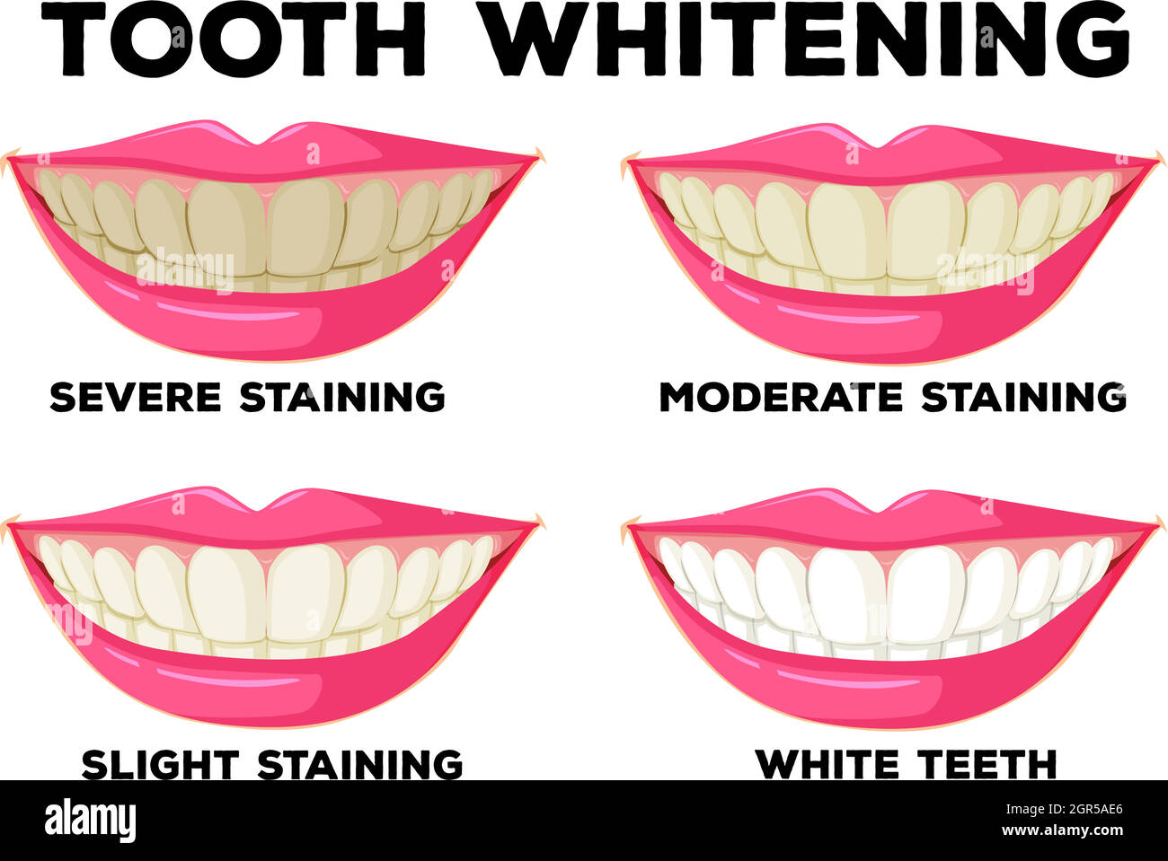 Prozess der Zahnaufhellung Stock Vektor