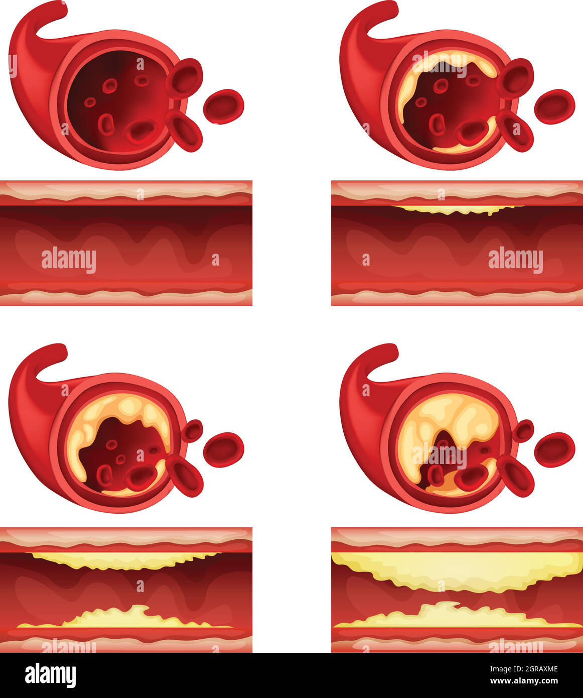 Diagramm mit Blutgerinnsel Stock Vektor