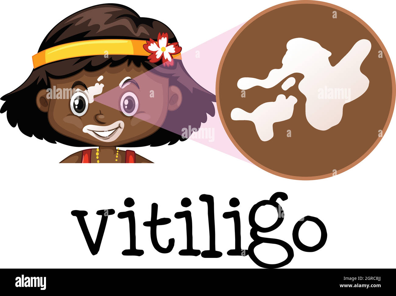 Human Medical Education von Vitiligo Stock Vektor