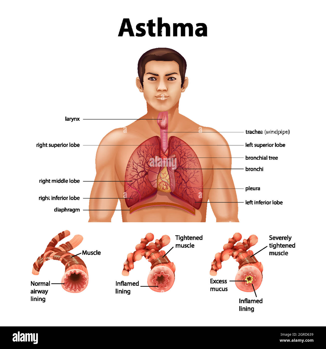 Vergleich von gesunder Lunge und asthmatischer Lunge Stock Vektor