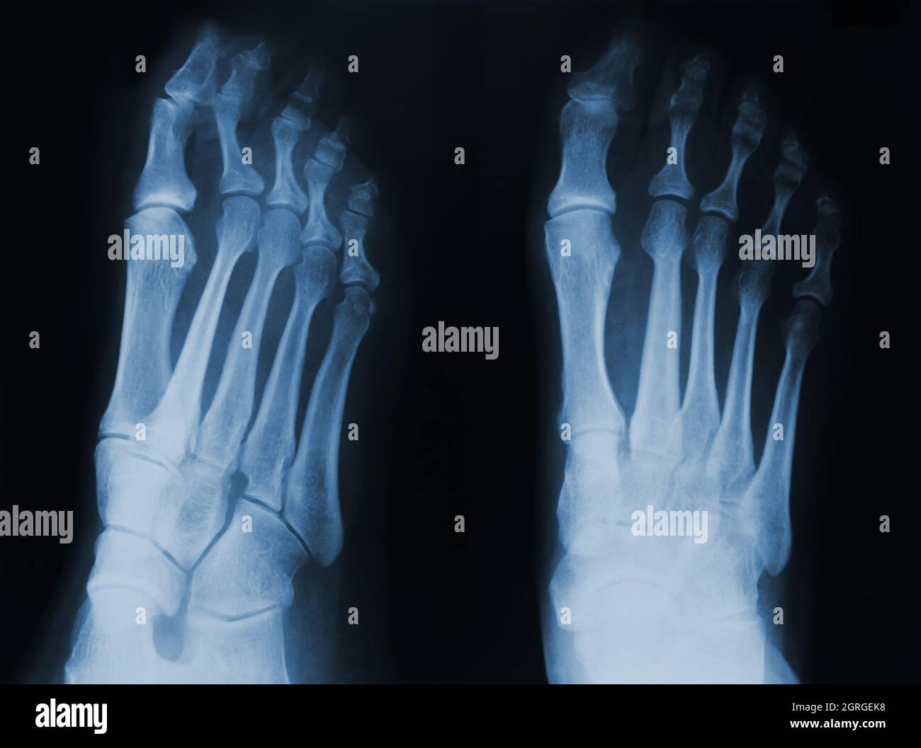 Röntgenaufnahme des menschlichen Fußes. Stockfoto