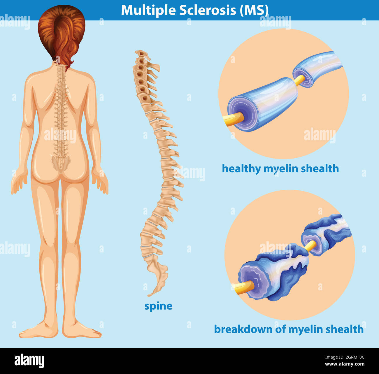 Ein Bildungsposter von Sklerose Stock Vektor