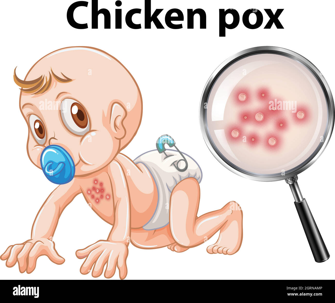 Ein Baby mit Hühnerpocken Stock Vektor