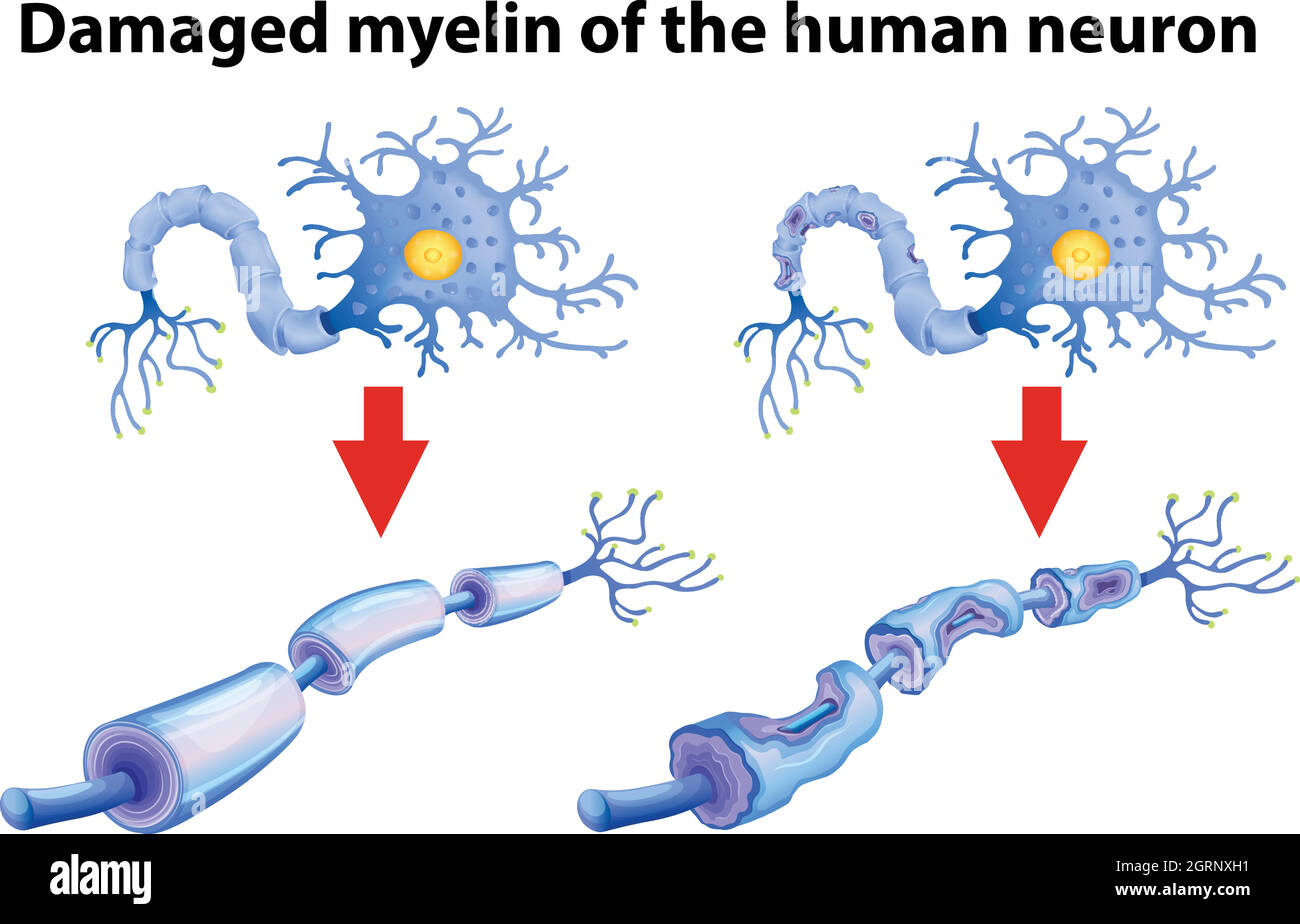 Myelin des menschlichen Neuron wurde beschädigt Stock Vektor