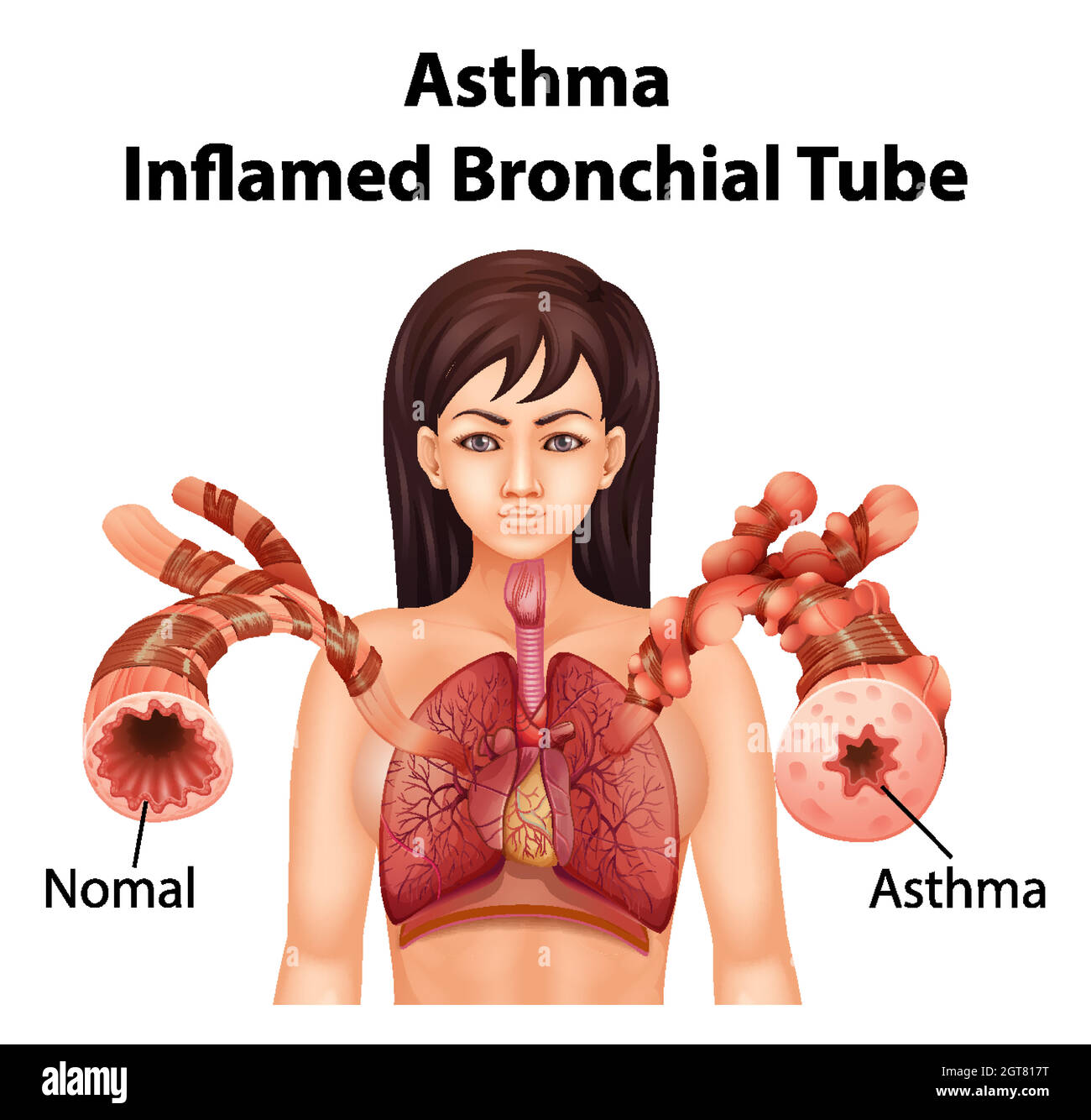 Asthma entzündete Bronchien Stock Vektor