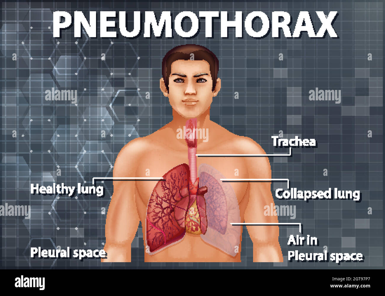 Informative Illustration des Pneumothorax Stock Vektor