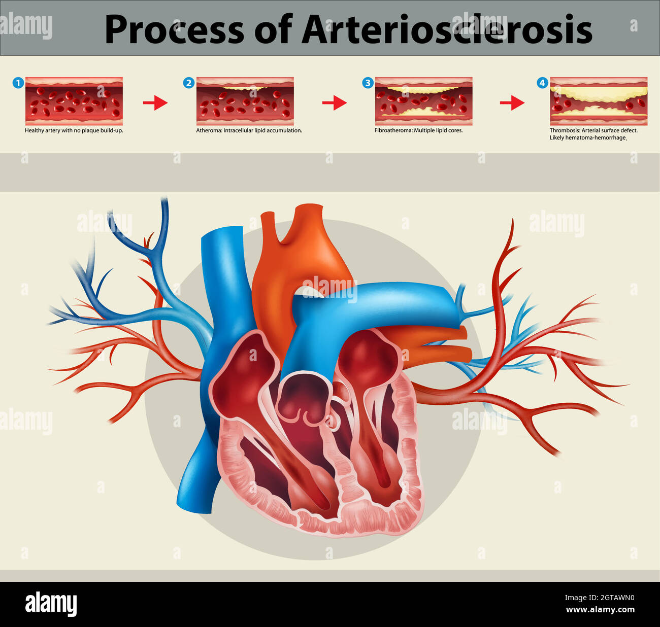 Plakat des Prozesses der Artriosklerose Stock Vektor