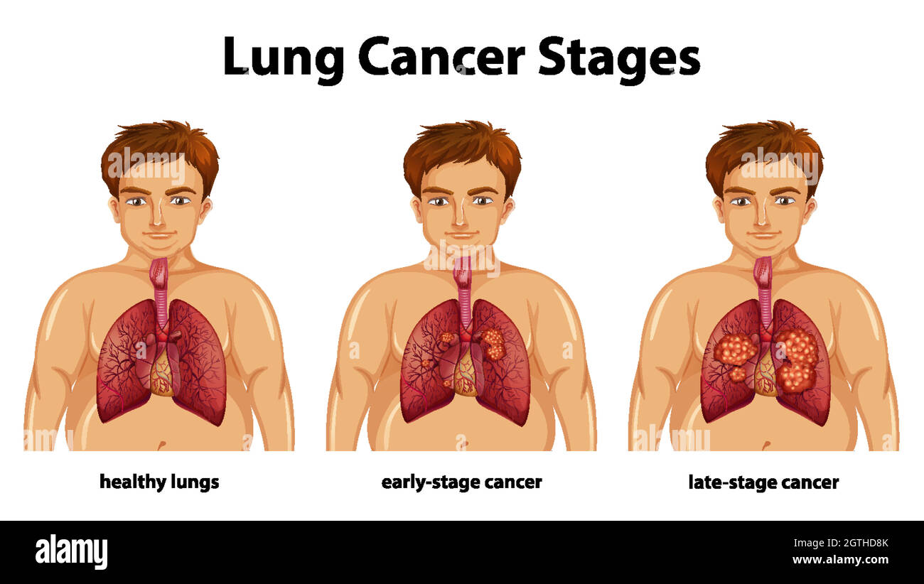 Informative Darstellung der Stadien von Lungenkrebs Stock Vektor